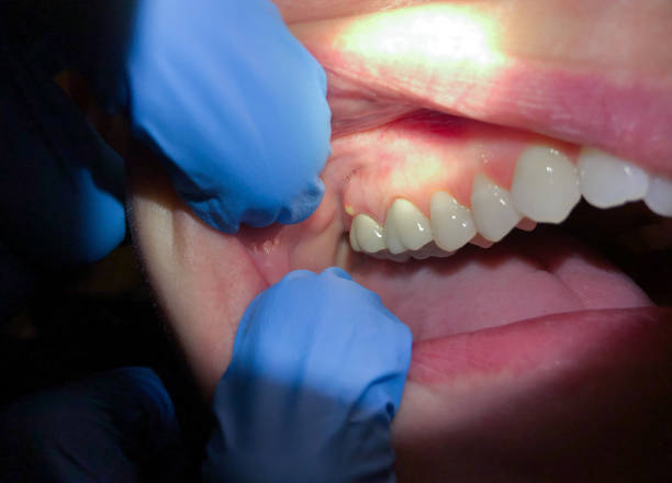 Best Knocked-Out Tooth Emergency  in Branchville, SC